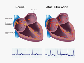 Atrial Fibrillation